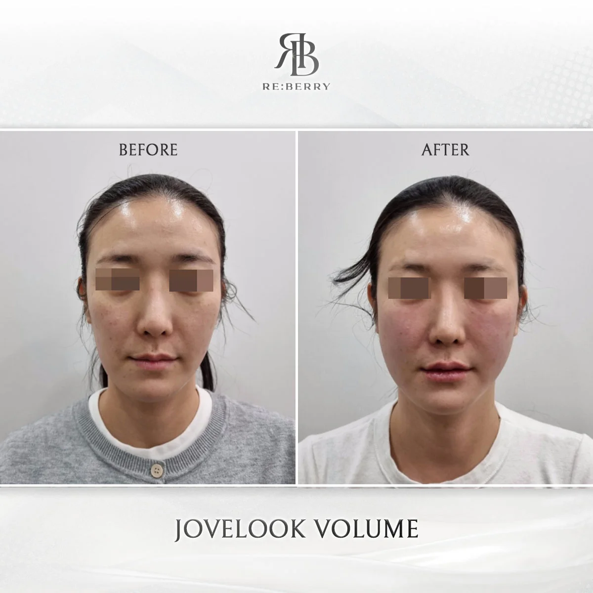 Dermal filler treatment results at RE:BERRY Myeongdong Seoul